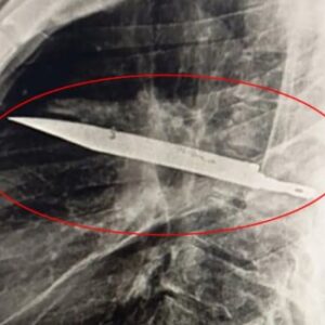 agri sikayetiyle gitti gogsunden bicak cikti 8 yil birlikte yasamis 46TcSYcV